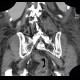 Pancolitis, acute colitis, colitis: CT - Computed tomography