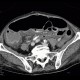 Pancolitis, acute colitis, colitis: CT - Computed tomography