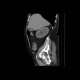 Parapelvic cysts, intrasinusoidal, central cysts: CT - Computed tomography