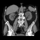 Parapelvic cysts, intrasinusoidal, central cysts: CT - Computed tomography