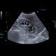 Parapelvic cysts, intrasinusoidal, central cysts: US - Ultrasound