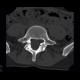 Spondylolysis, spondylolisthesis, olisthesis: CT - Computed tomography