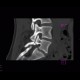 Spondylolysis, spondylolisthesis, olisthesis: CT - Computed tomography