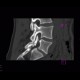 Spondylolysis, spondylolisthesis, olisthesis: CT - Computed tomography