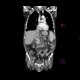 Thrombosis of portal and mesenteric vein: CT - Computed tomography
