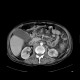Thrombosis of portal and mesenteric vein: CT - Computed tomography