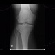 Patella bipartita, bipartite patella: X-ray - Plain radiograph