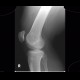 Patella bipartita, bipartite patella: X-ray - Plain radiograph