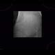 Patella bipartita, bipartite patella: X-ray - Plain radiograph