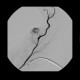 Neovascularisation in tumour of biceps brachii: AG - Angiography