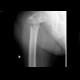 Subtronchanteric fracture of femur, pathologic fracture, bone metastasis: X-ray - Plain radiograph
