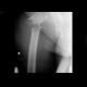 Subtronchanteric fracture of femur, pathologic fracture, bone metastasis: X-ray - Plain radiograph