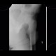 Hip fracture, femoral neck, subcapital fracture, Pauwels A: X-ray - Plain radiograph