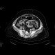 Peritonitis, perforation of large bowel: CT - Computed tomography