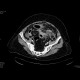 Peritonitis, perforation of large bowel: CT - Computed tomography