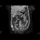 Peritonitis, perforation of large bowel: CT - Computed tomography