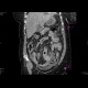 Peritonitis, perforation of large bowel: CT - Computed tomography