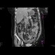Peritonitis, perforation of large bowel: CT - Computed tomography