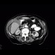 Perforation of gastric ulcer, stomach ulcer: CT - Computed tomography