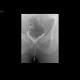 Perineal fistula, communicating with rectum: RF - Fluoroscopy