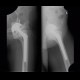 Periarticular ossifications after replacement of hip joint, pseudoarthrosis, false joint: X-ray - Plain radiograph