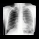 Peribronchitis: X-ray - Plain radiograph