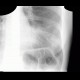 Peribronchitis: X-ray - Plain radiograph