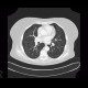 Ground-glass in acute leukemia, lymphocyte infiltration, peribronchovascular: CT - Computed tomography