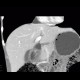 Pericardial cyst: CT - Computed tomography