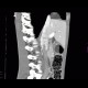 Pericardial cyst: CT - Computed tomography