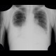 Pericardial effusion after myocardial biopsy, after: X-ray - Plain radiograph