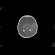 Perinatal thrombosis of the left middle cerebral artery, MCA: MRI - Magnetic Resonance Imaging