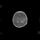 Perinatal thrombosis of the left middle cerebral artery, MCA: MRI - Magnetic Resonance Imaging