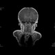 Perinatal thrombosis of the left middle cerebral artery, MCA: MRI - Magnetic Resonance Imaging