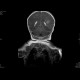 Perinatal thrombosis of the left middle cerebral artery, MCA: MRI - Magnetic Resonance Imaging