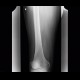 Periostosis of femur: X-ray - Plain radiograph