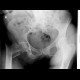 Pertrochanteric fracture of the femur: X-ray - Plain radiograph