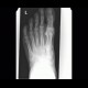 Foreign body in the foot, pipette: X-ray - Plain radiograph