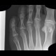 Foreign body in the foot, pipette: X-ray - Plain radiograph