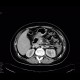 Fistula, retroperitoneal: CT - Computed tomography