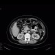 Fistula, retroperitoneal: CT - Computed tomography