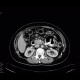 Fistula, retroperitoneal: CT - Computed tomography