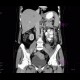 Fistula, retroperitoneal: CT - Computed tomography