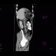 Fistula, retroperitoneal: CT - Computed tomography