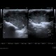 Pleomorphic adenoma, parotid gland: US - Ultrasound