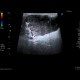 Pleomorphic adenoma, parotid gland: US - Ultrasound