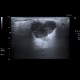 Pleomorphic adenoma, parotid gland: US - Ultrasound