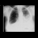 Pleural effusion: X-ray - Plain radiograph