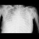 Pleural effusion, supine radiograph, before and after evacuation: X-ray - Plain radiograph