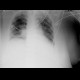 Lung edema, before and after therapy: X-ray - Plain radiograph